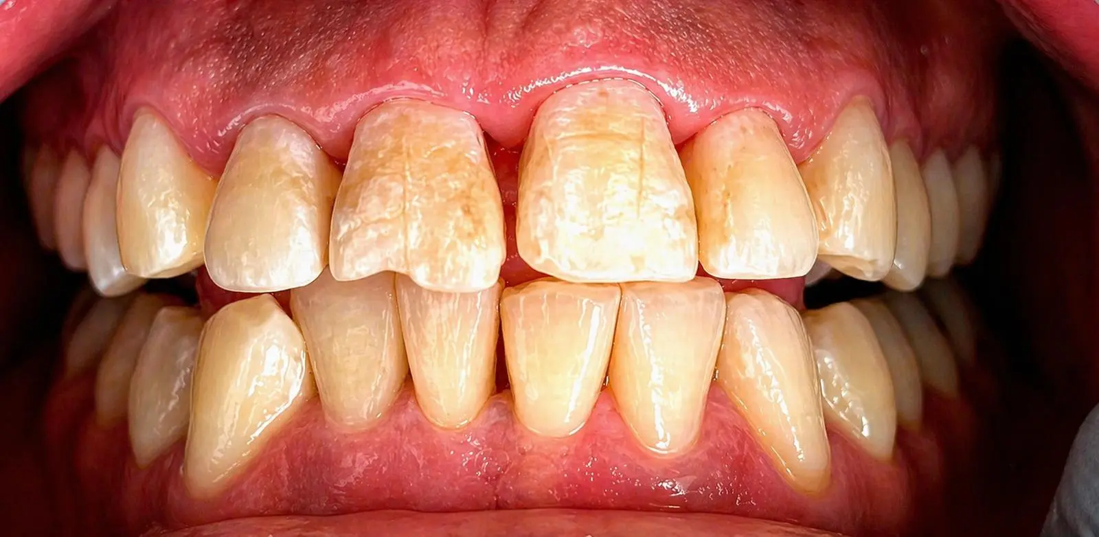 frontal view of dental staining and aesthetic structural concerns prior to clinical adjustments