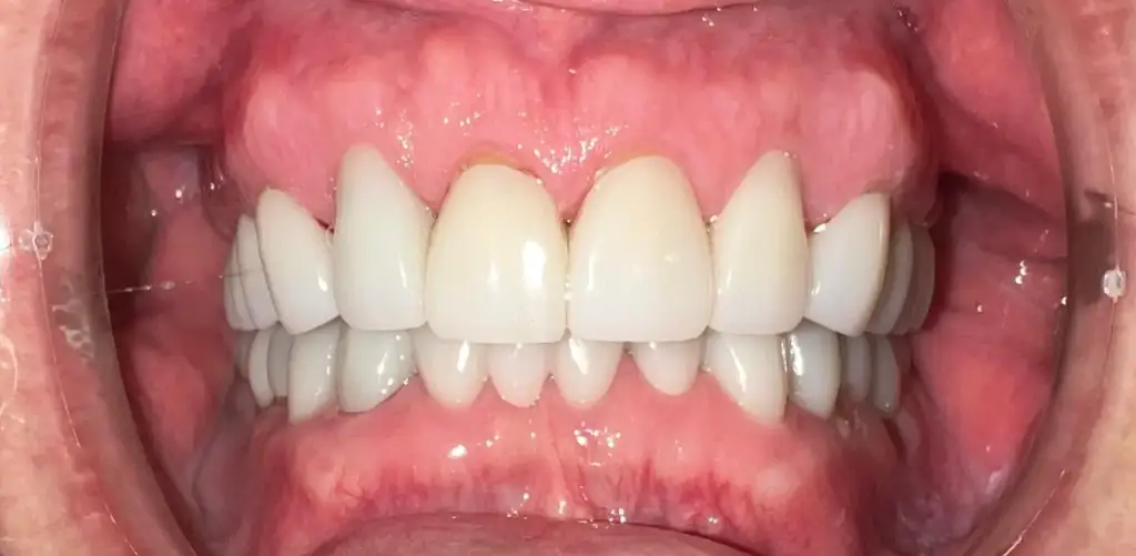 frontal view of a brightened rejuvenated smile line following comprehensive dental rehabilitation