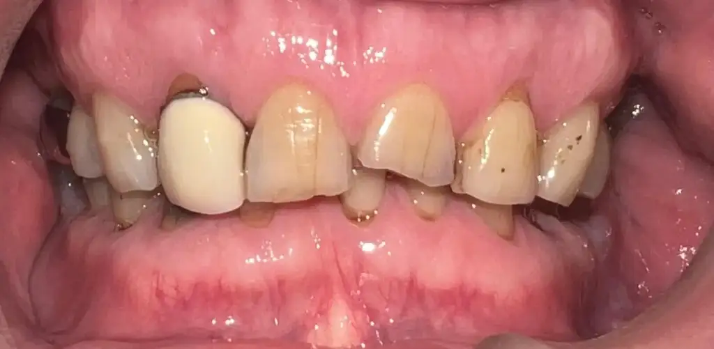frontal view of dental staining and aesthetic structural concerns prior to clinical adjustments