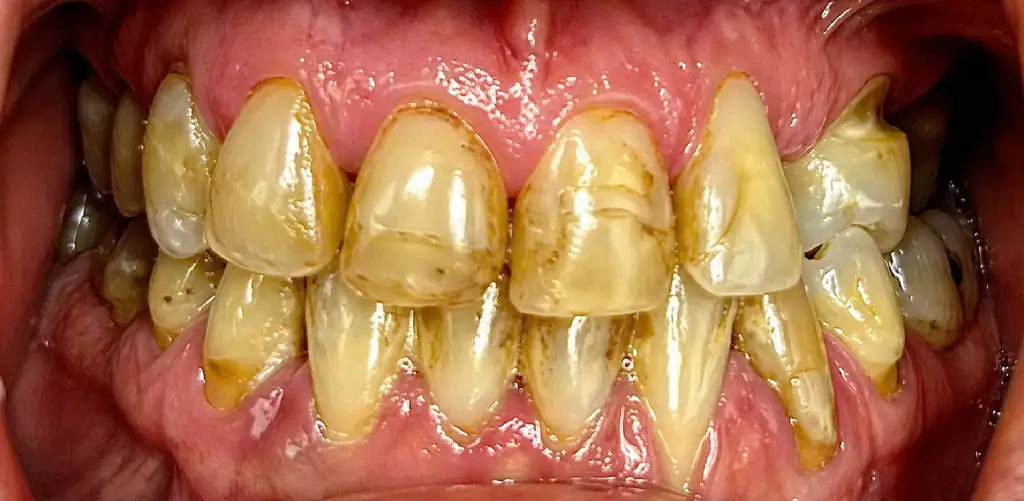 frontal view of dental staining and aesthetic structural concerns prior to clinical adjustments