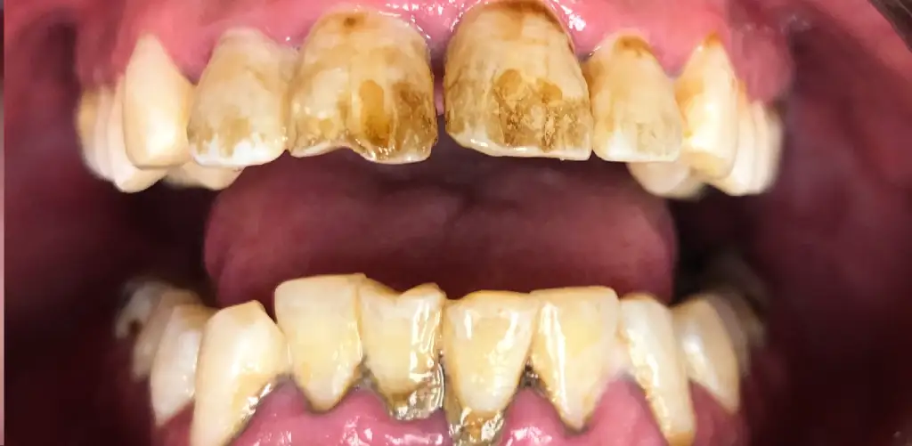 patient smile showing shifting alignment or visible spaces before restorative care